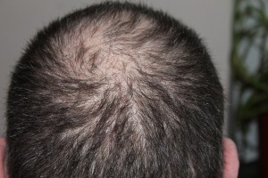Männer sind deutlich öfter vom Haarausfall betroffen